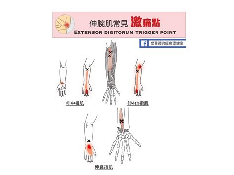 骨節手|手肘痛、手腕痛、手指痛的原因,治療與自我檢查 » 台。